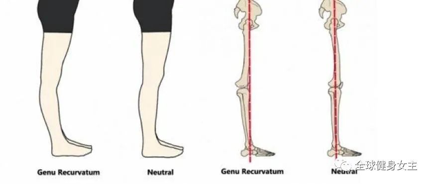 想穿裙子腿型不好看？5个动作矫正XO型腿，get铅笔腿