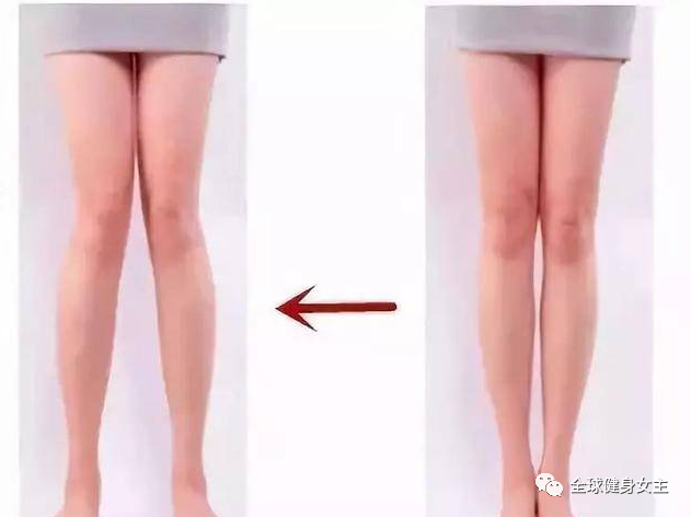 X型腿很难看？简单几个方法，有效调整你的腿型