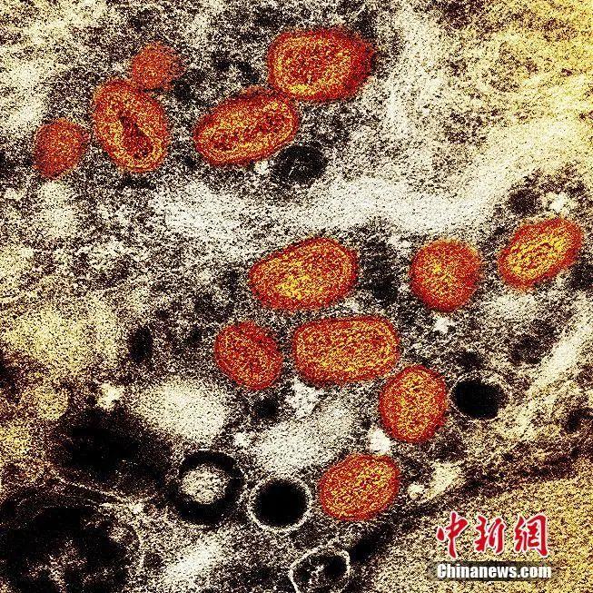  资料图：当地时间2022年7月26日，美国马里兰州，在实验室培养的感染细胞（棕色）中发现的猴痘颗粒（橙色）的彩色透射电子显微图。图片来源：视觉中国