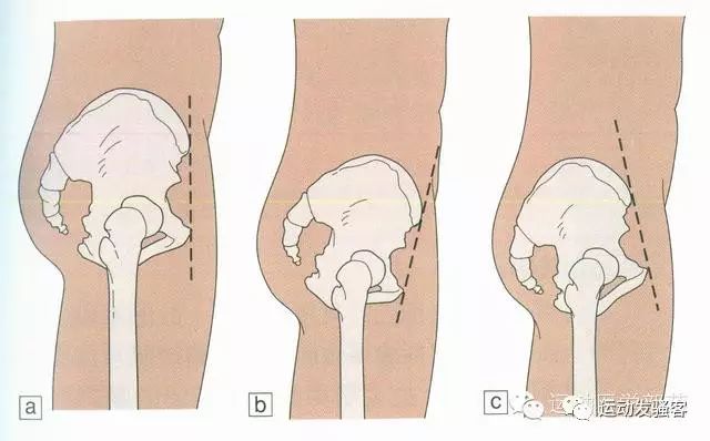 你是“真翘臀”还是“骨盆前倾”？假如是骨盆前倾，该怎么办？