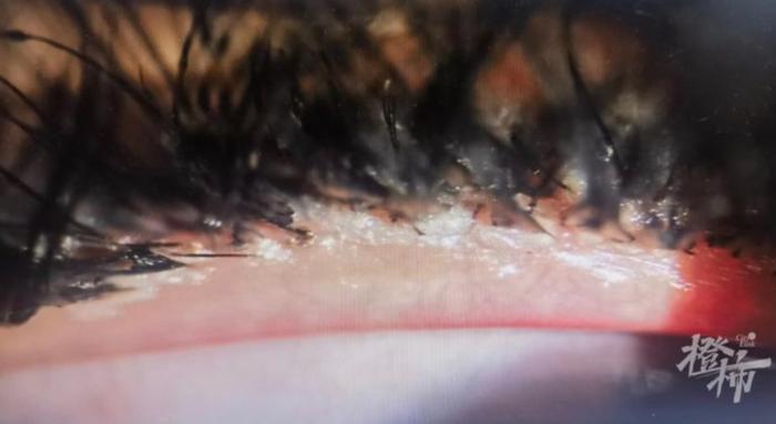 裂隙灯显微镜下照片显示睫毛根部（睑缘）充血、沾满了胶水